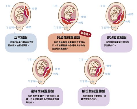 完全性前置胎盤